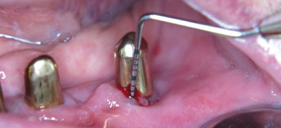 Präimplantologische Planung bei Parodontitis-Patienten