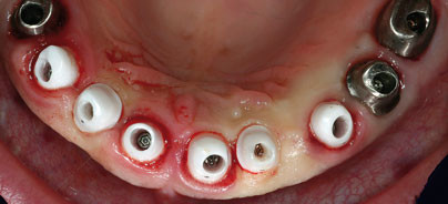 Sofortimplantation bei schwerer Paro­dontitis durch transdentale 3-D-Planung