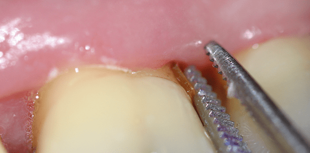 Parodontalbehandlung nicht ohne Nachsorge