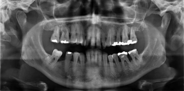 „Bearbeitung“ von Wurzeloberflächen bei Parodontitis