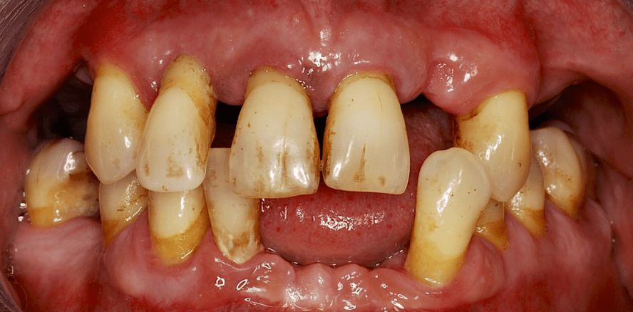 Prävalenzzahlen zu Parodontitis in Österreich „Fehlanzeige“