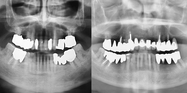 Die parodontalprothetische Behandlungsstrategie