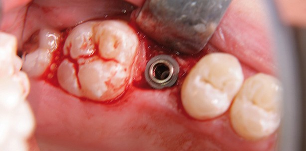Interner Sinuslift mit periointegrativem ­Implantat