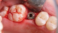 Interner Sinuslift mit periointegrativem ­Implantat