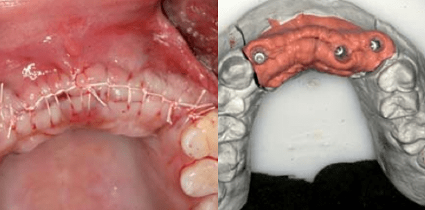 Vom Problem zur Lösung – Komplikationsmanagement in der GBR