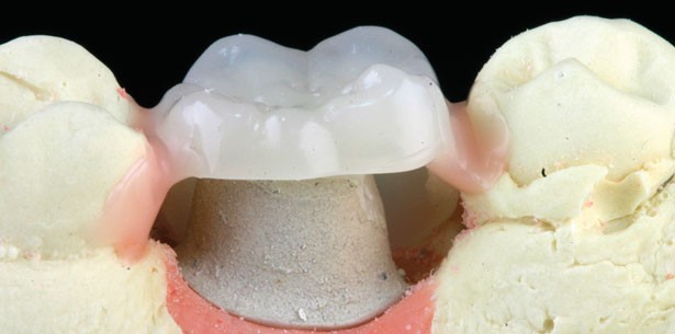 PEEK – Hochleistungskunststoffe im implantatprothetischen Workflow