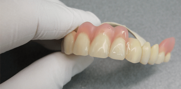 Neuer Kunststoff ermöglicht Prognose der prothetischen Versorgung