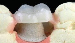PEEK – Hochleistungskunststoffe im implantatprothetischen Workflow
