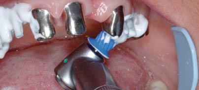 Risikovermeidung einer Periimplantitis