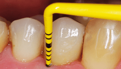 Periimplantäre Erkrankungen – Erkennen, Therapieren und Vorbeugen