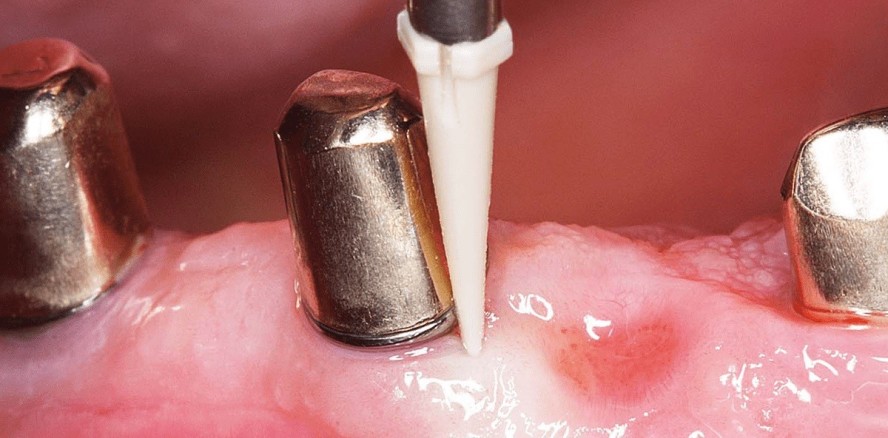 Periimplantäre Erkrankungen – Erkennen, Therapieren und Vorbeugen