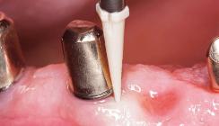 Periimplantäre Erkrankungen – Erkennen, Therapieren und Vorbeugen