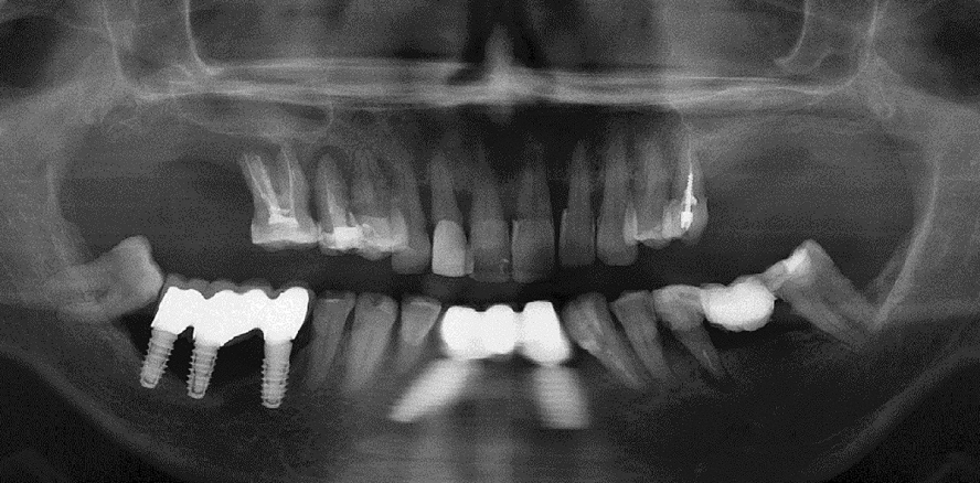 Periimplantitis: Analyse und Hinweise zur Implantatauswahl