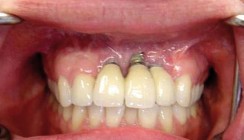 Erfolgreiche Periimplantitisprophylaxe