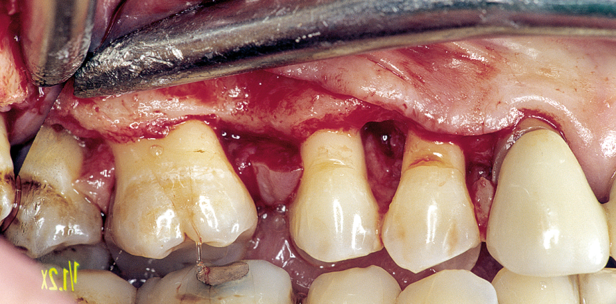 Implantatplanung: Relevanz für periimplantäre Erkrankungen