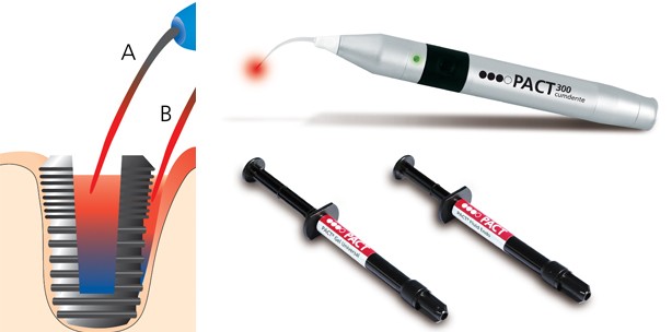 PACT zur Therapie und Prophylaxe der Periimplantitis