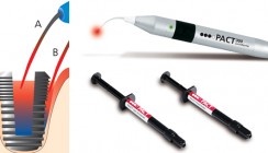 PACT zur Therapie und Prophylaxe der Periimplantitis