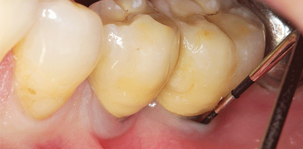 Periimplantitis – Eine Herausforderung