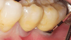 Periimplantitis – Eine Herausforderung