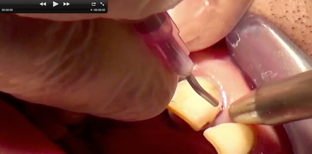 Parodontitis & Periimplantitis: Experte erklärt Therapiemethode