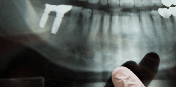 Entstehung und Progression periimplantärer Erkrankungen