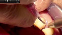 Parodontitis & Periimplantitis: Experte erklärt Therapiemethode