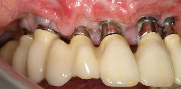 Kurzübersicht Periimplantitis: Risikofaktoren und Therapiemöglichkeiten