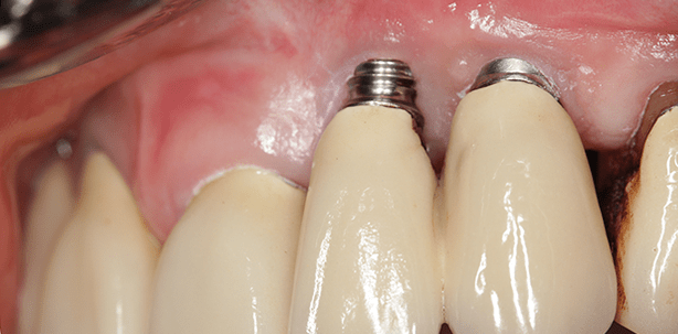 Periimplantitis – Das sollte man wissen