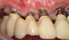 Kurzübersicht Periimplantitis: Risikofaktoren und Therapiemöglichkeiten