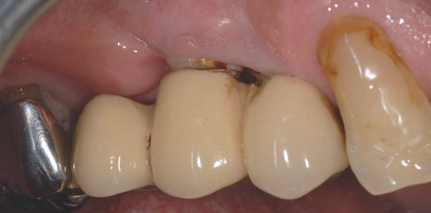 Therapieoption lokale Antibiose bei periimplantären Erkrankungen