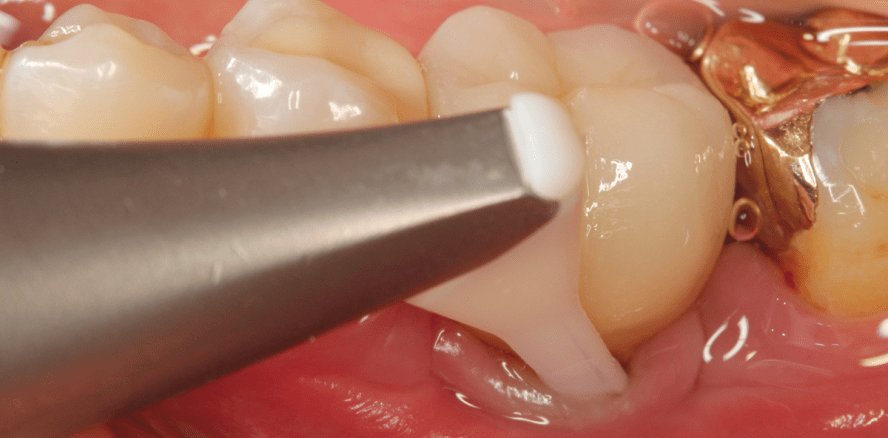 Moderne Periimplantitistherapie