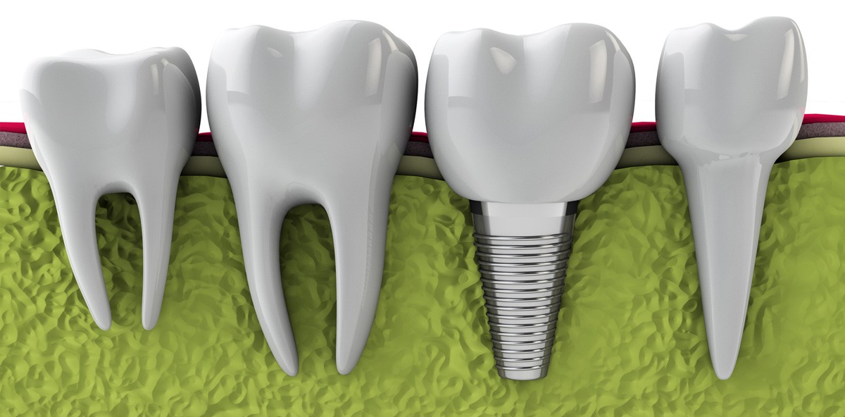 Abrechnung der Periimplantitistherapie