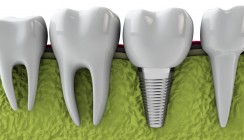 Abrechnung der Periimplantitistherapie