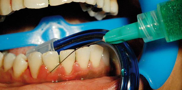 Photothermische Therapie mit perio green®