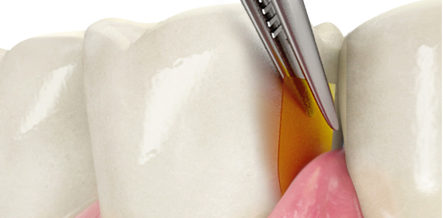 Sicher und wirksam gegen Parodontitis