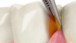 Sicher und wirksam gegen Parodontitis