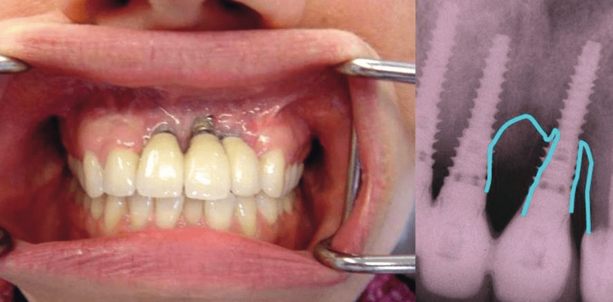 Erfolgreiche Periimplantitisprophylaxe