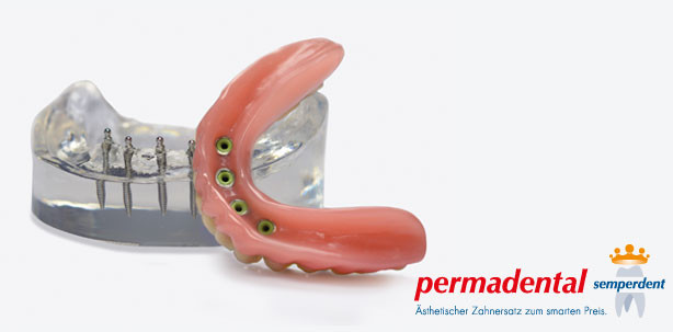 PERMADENTAL kooperiert mit Mini-Implantat-Hersteller