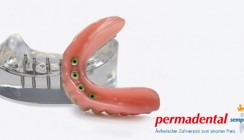 PERMADENTAL kooperiert mit Mini-Implantat-Hersteller