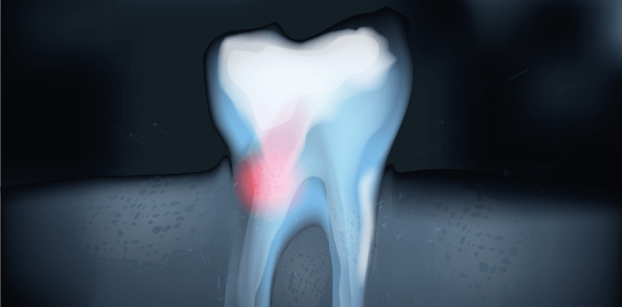 Zahnkronen: Langzeitschutz vor Bakterien möglich