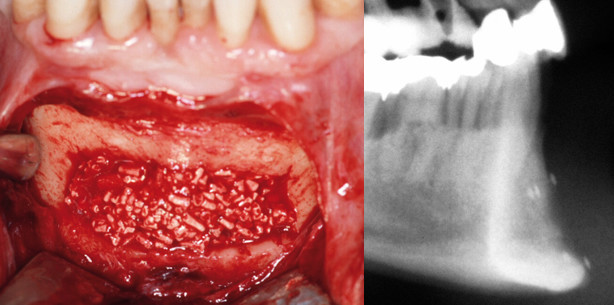 Die pflanzliche Alternative zu bovinen Biomaterialien