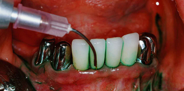 Photodynamische Therapien – Blau versus Grün