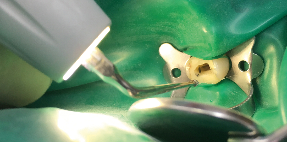 Piezotechnik in der Endodontie