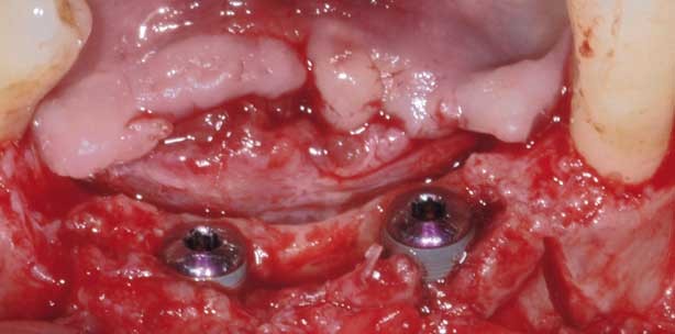 Piezoelektrisches Bone Splitting und Implantation