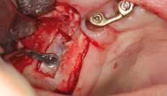 Piezochirurgie: Minimalinvasive präimplantologische Maßnahmen