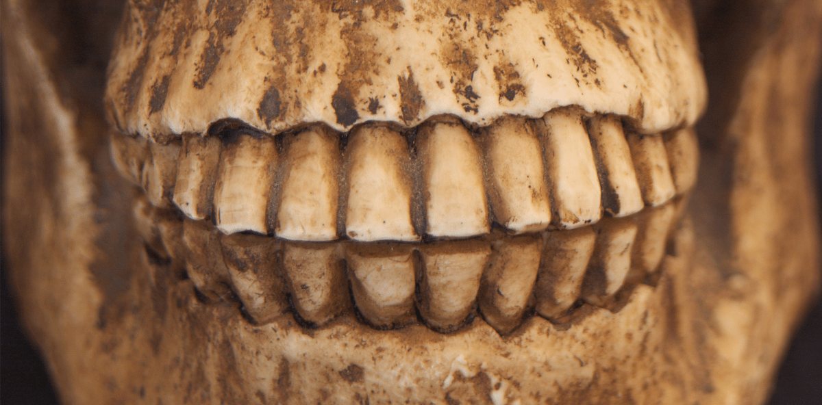 Plaque enthält mehr DNA als Zähne oder Knochen