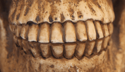 Plaque enthält mehr DNA als Zähne oder Knochen