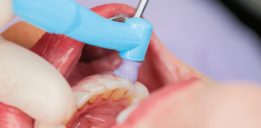 Bedeutung guter Prophylaxe­winkelstücke und Poliernäpfe