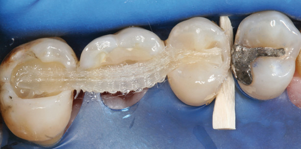 Zahnschienung nach chirurgisch-korrektiver Parodontaltherapie