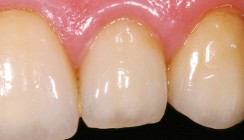 Postendodontische Versorgung – ­ästhetische und funktionelle Aspekte